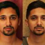 Male Rhinoplasty Before & After Patient #11514