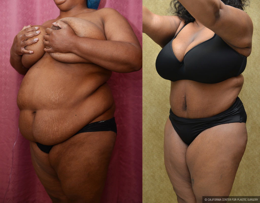 Tummy Tuck (Abdominoplasty) Plus Size Before & After Patient #11538