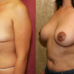 Breast Lift - Moderate Before & After Patient #11801