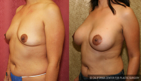 Breast Lift - Moderate Before & After Patient #11801