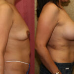 Breast Lift - Moderate Before & After Patient #11801