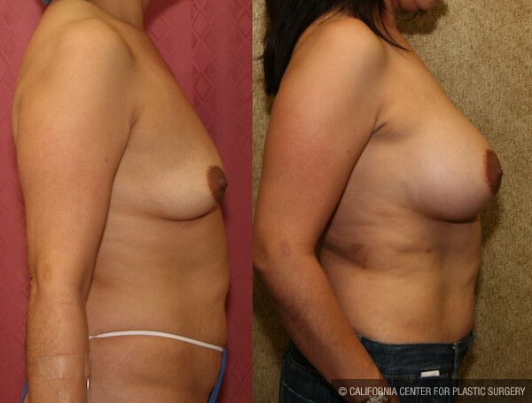 Breast Lift - Moderate Before & After Patient #11801