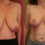 Breast Lift - Full Before & After Patient #11805