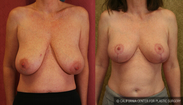 Breast Lift - Full Before & After Patient #11805