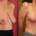 Breast Lift - Full Before & After Patient #11805