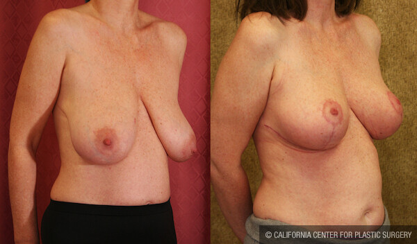 Breast Lift - Full Before & After Patient #11805