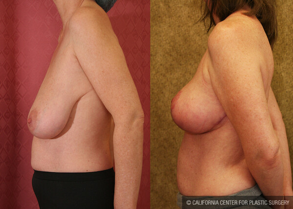 Breast Lift - Full Before & After Patient #11805