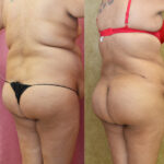 Buttock Lift/Augmentation Before & After Patient #11816