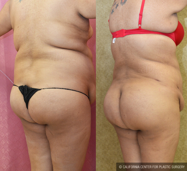 Buttock Lift/Augmentation Before & After Patient #11816