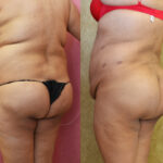 Buttock Lift/Augmentation Before & After Patient #11816