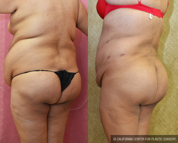 Buttock Lift/Augmentation Before & After Patient #11816