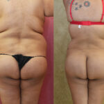 Buttock Lift/Augmentation Before & After Patient #11816