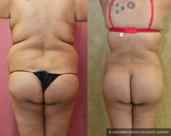 Buttock Lift/Augmentation Before & After Patient #11816