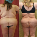 Buttock Lift/Augmentation Before & After Patient #11821