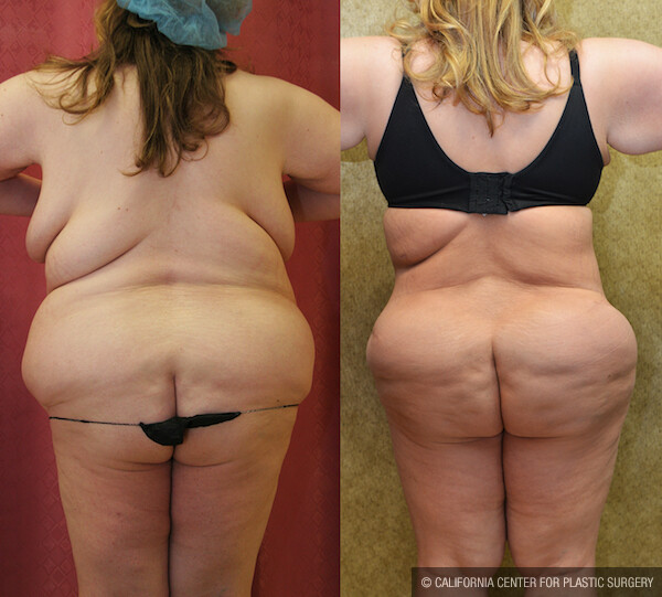 Buttock Lift/Augmentation Before & After Patient #11821