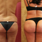 Buttock Lift/Augmentation Before & After Patient #11823