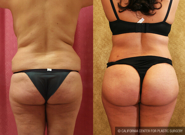 Buttock Lift/Augmentation Before & After Patient #11823