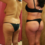 Buttock Lift/Augmentation Before & After Patient #11823