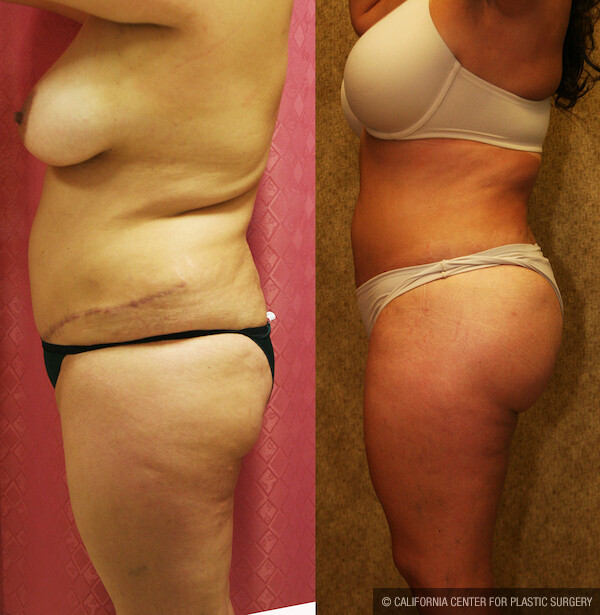 Buttock Lift/Augmentation Before & After Patient #11823