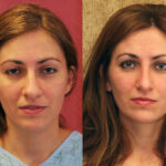 Rhinoplasty - Caucasian Before & After Patient #11871