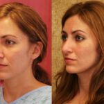 Rhinoplasty - Caucasian Before & After Patient #11871