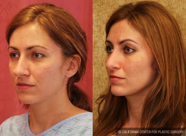 Rhinoplasty - Caucasian Before & After Patient #11871