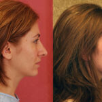 Rhinoplasty - Caucasian Before & After Patient #11871