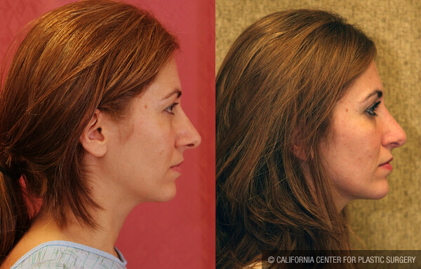 Rhinoplasty - Caucasian Before & After Patient #11871