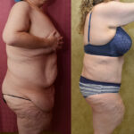 Tummy Tuck (Abdominoplasty) Plus Size Before & After Patient #11896