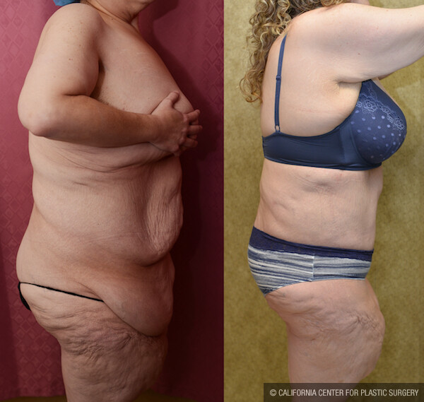 Tummy Tuck Plus Size Before & After Patient #11896