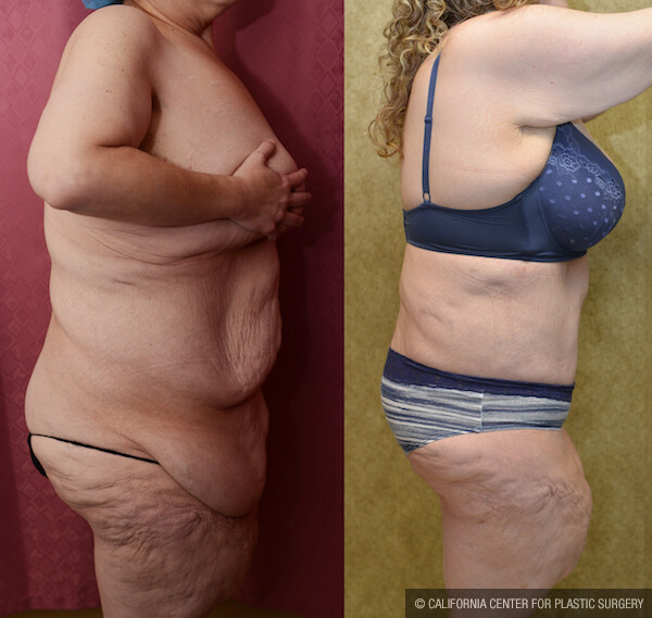 Tummy Tuck (Abdominoplasty) Plus Size Before & After Patient #11896