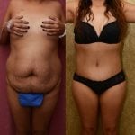 Tummy Tuck (Abdominoplasty) Plus Size Before & After Patient #11931