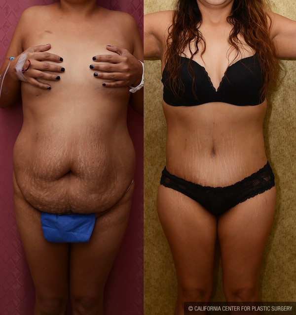 Tummy Tuck (Abdominoplasty) Plus Size Before & After Patient #11931