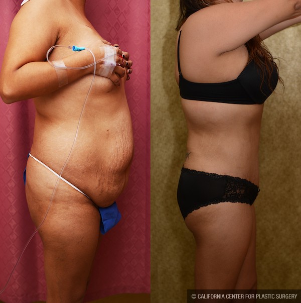 Tummy Tuck (Abdominoplasty) Plus Size Before & After Patient #11931