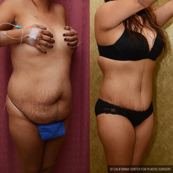 Tummy Tuck (Abdominoplasty) Plus Size Before & After Patient #11931
