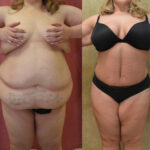 Tummy Tuck (Abdominoplasty) Plus Size Before & After Patient #11900