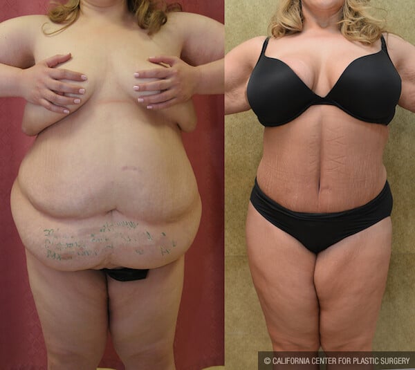 Tummy Tuck (Abdominoplasty) Plus Size Before & After Patient #11900