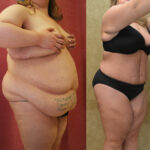 Tummy Tuck (Abdominoplasty) Plus Size Before & After Patient #11900