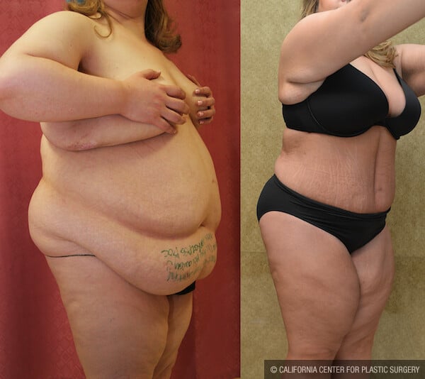 Tummy Tuck (Abdominoplasty) Plus Size Before & After Patient #11900