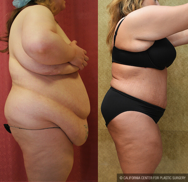 Tummy Tuck (Abdominoplasty) Plus Size Before & After Patient #11900