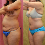 Tummy Tuck (Abdominoplasty) Small Size Before & After Patient #11908