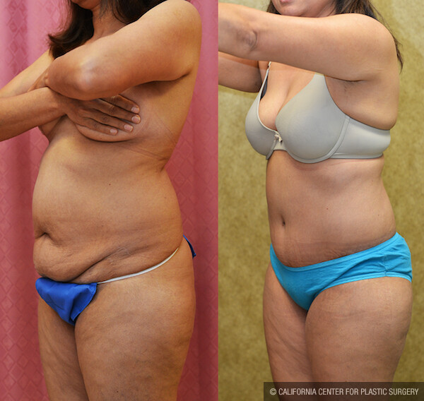 Tummy Tuck (Abdominoplasty) Small Size Before & After Patient #11908