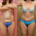 Tummy Tuck (Abdominoplasty) Small Size Before & After Patient #11908