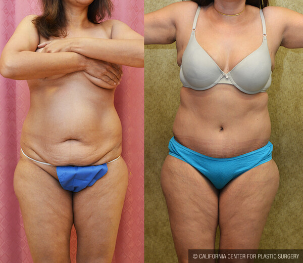 Tummy Tuck (Abdominoplasty) Small Size Before & After Patient #11908