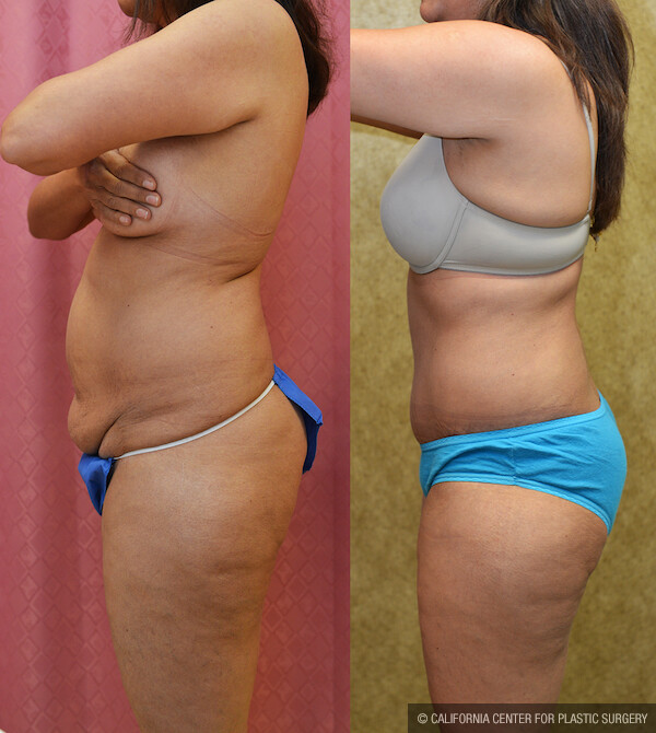 Tummy Tuck (Abdominoplasty) Small Size Before & After Patient #11908