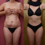 Tummy Tuck (Abdominoplasty) Small Size Before & After Patient #11912