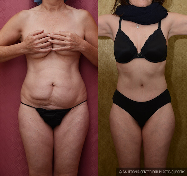 Tummy Tuck (Abdominoplasty) Small Size Before & After Patient #11912