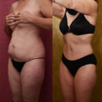 Tummy Tuck (Abdominoplasty) Small Size Before & After Patient #11912