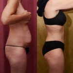 Tummy Tuck (Abdominoplasty) Small Size Before & After Patient #11912