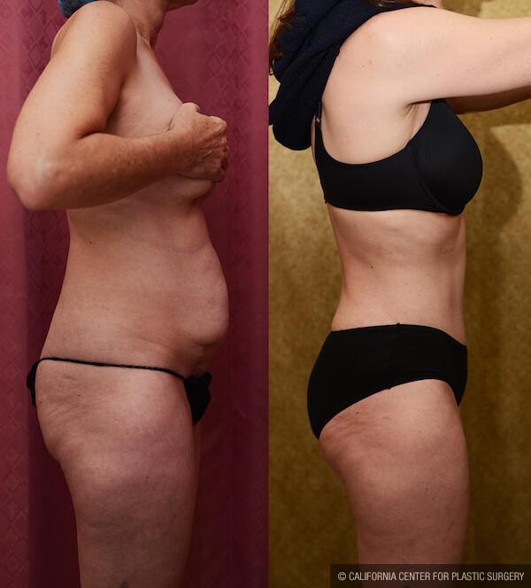 Tummy Tuck (Abdominoplasty) Small Size Before & After Patient #11912